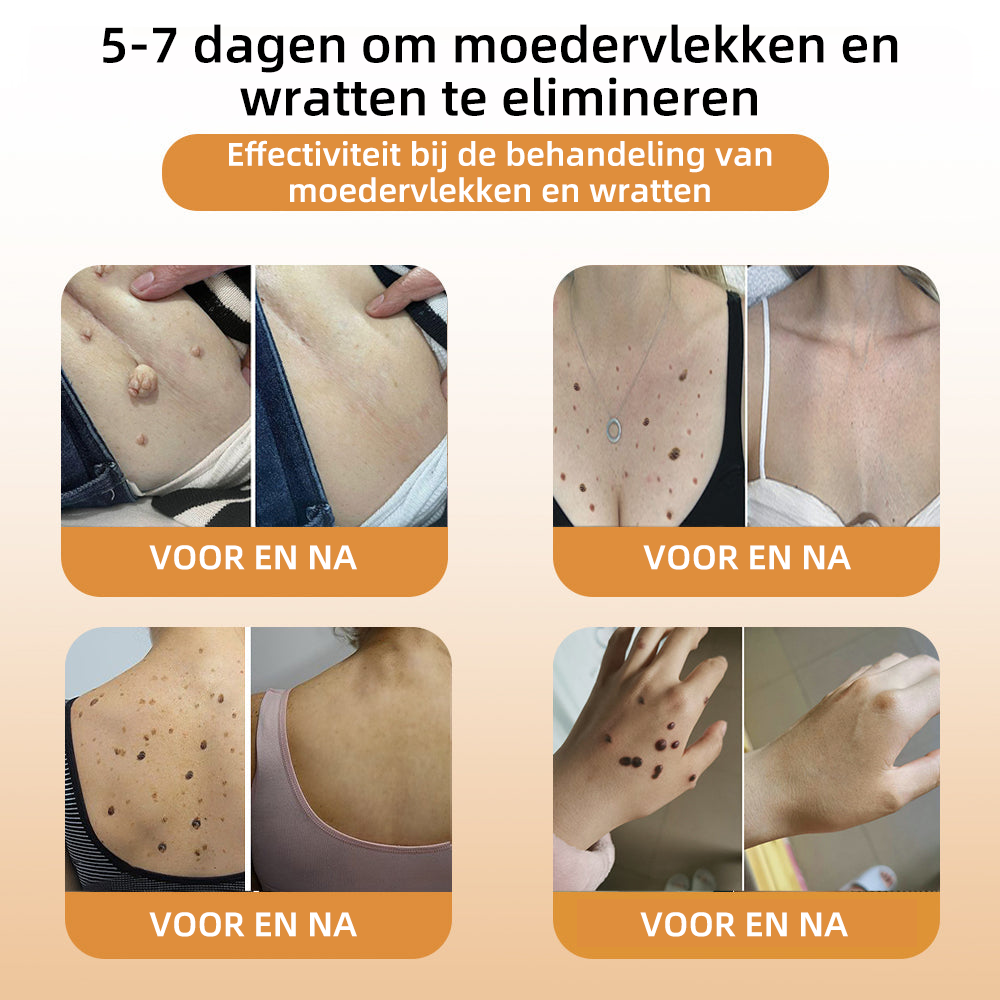 🚁WREE™ Bijengif wrat- en tagverwijderingscrème (👨‍⚕Geschikt voor alle huidtypes)🐝(🔥Laatste dag promotie 60% korting)